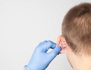 ניתוח הצמדת אוזניים Min
